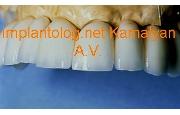 Имплантация зубов фиксация с помощью усиленной армированной конструкции